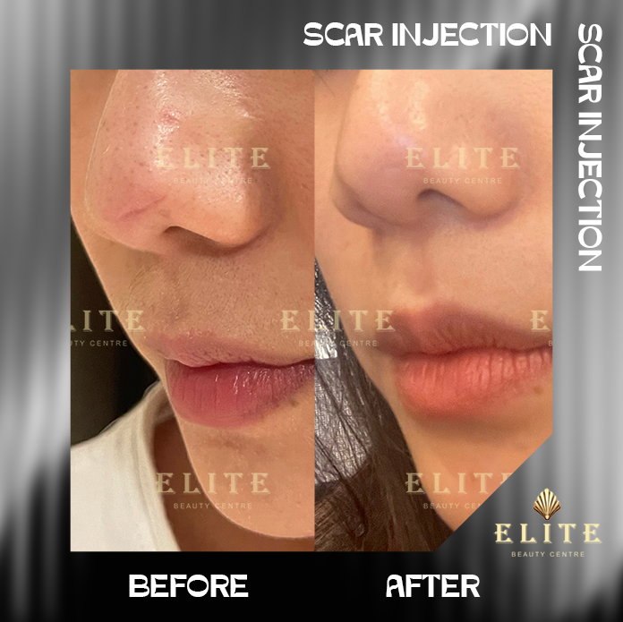 SCAR INJECTION